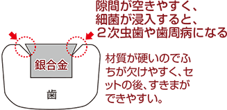 セラミックの詰め物が2次虫歯になりにくい理由